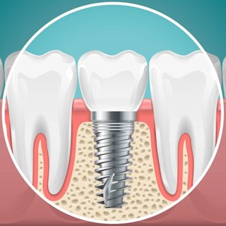 implantat___serialized1.jpg