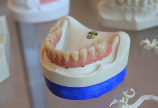 tandimplantat-img2.jpg