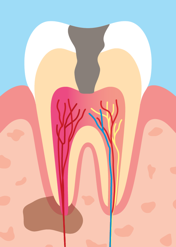 Infektion i tanden. Tandvärk