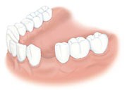Saknad tand Implantat