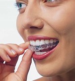 Tandreglering, Osynlig tandställning, ojämna tänder, estetisk tandvård, snygga tänder, jämn tandrad, 